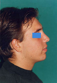 Chirurgia Estetica - Rinoplastica - foto prima dopo.